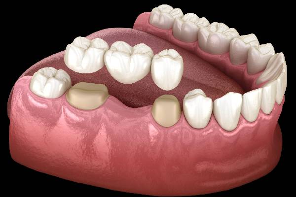 Dental Bridge